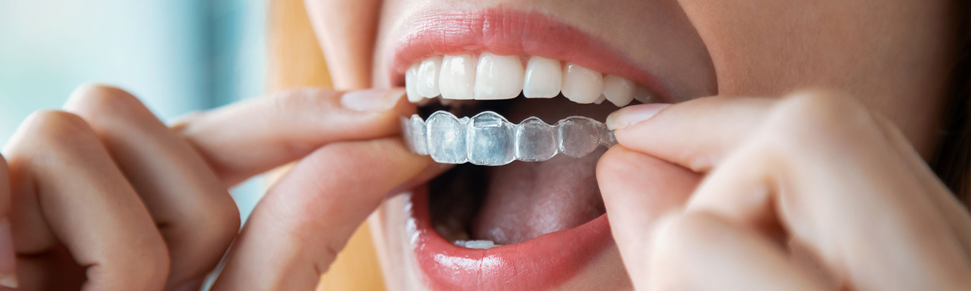 Orthodontics Whittier CA