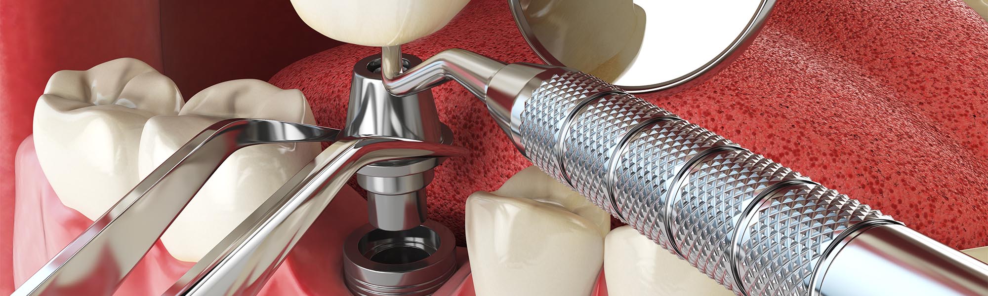 Single Tooth Implants in Whittier CA