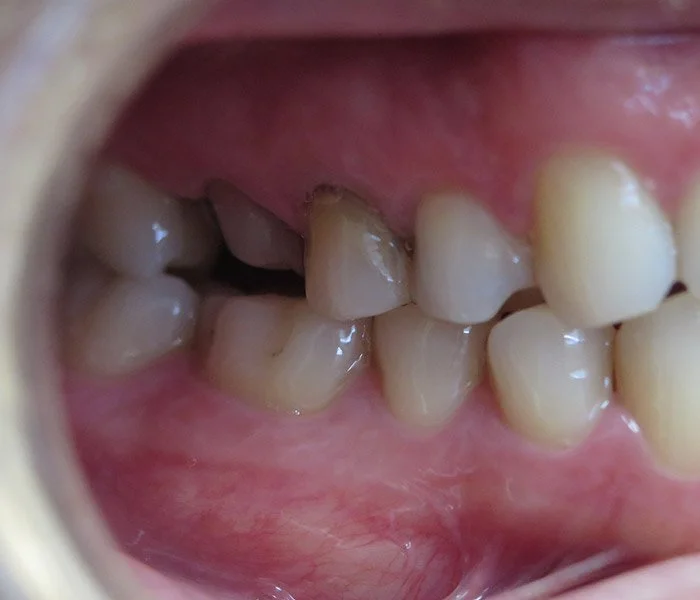 emergency dentist Whittier Before