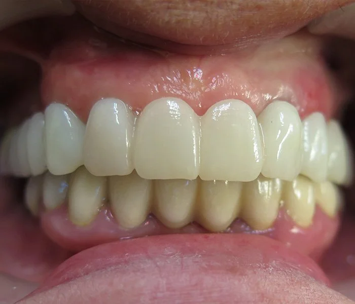 Dental Implants Whittier After