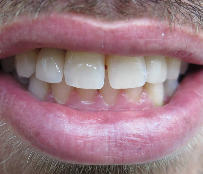 Dental Implants Whittier After