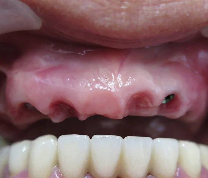 Dental Implants Whittier Before
