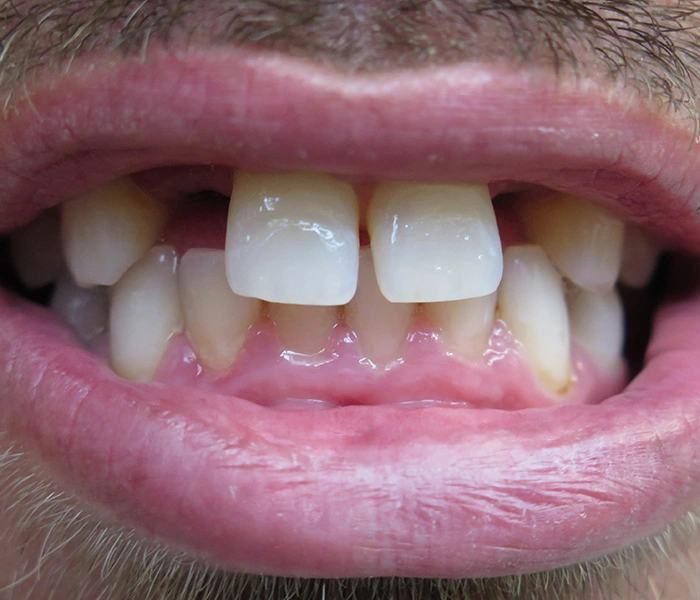 Dental Implants Whittier Before